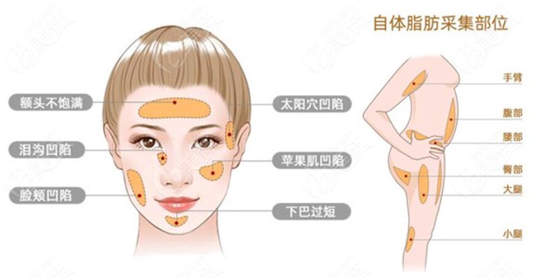面部自体脂肪填充