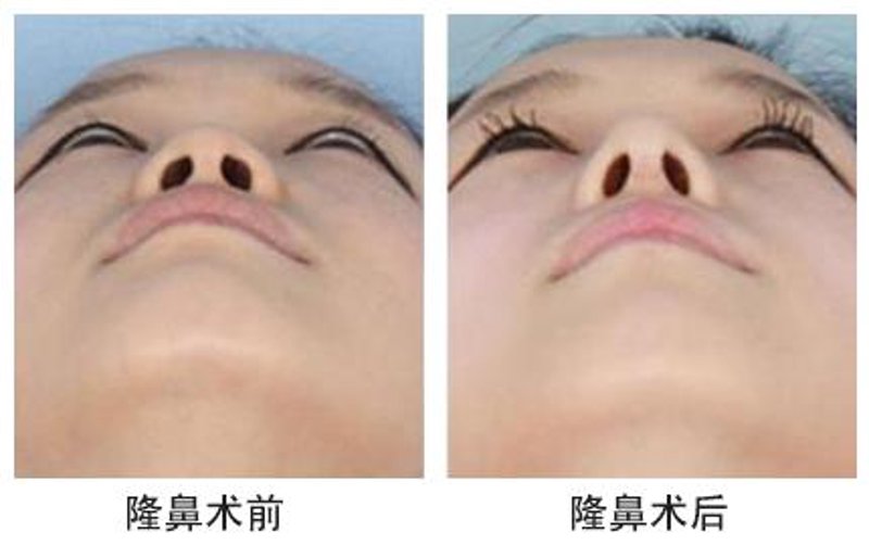 双眼皮手术价格：揭秘行业动态